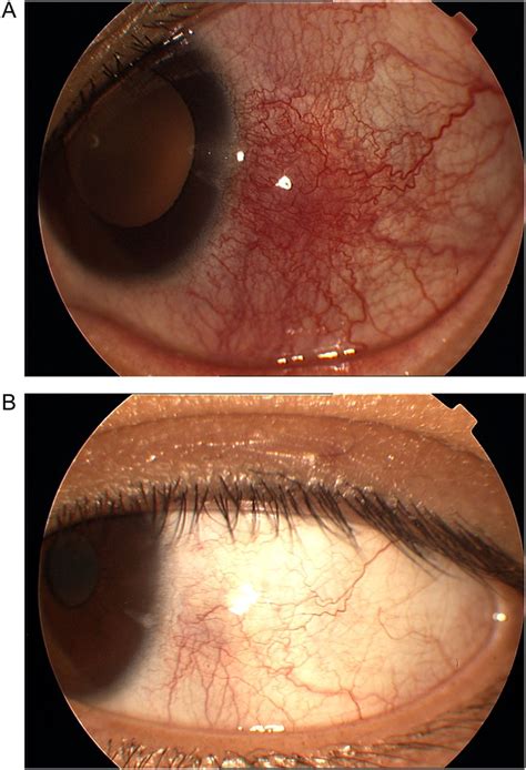 Clinical Manifestations And Outcome Of Tuberculous Sclerokeratitis