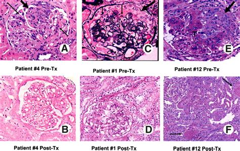 Clinical Presentation Natural History And Treatment Of Crescentic Proliferative Iga