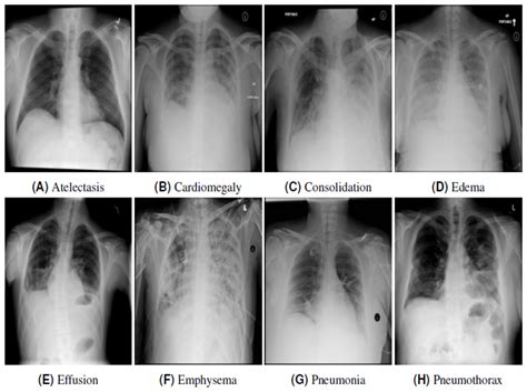 Atelectasis Vs Pneumonia X Ray