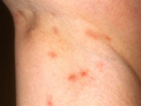 Rashes That Look Like Scabies Causes Symptoms And Treatment