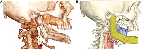 A, Surgery outcome for Case 4. Due to an intraoperative reversal of the ...