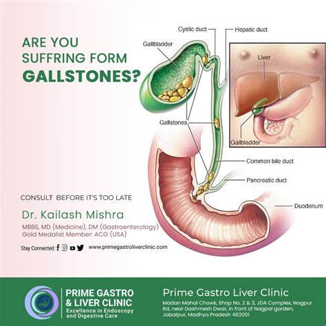 What Is Gallstones Symptoms Causes Treatment And More