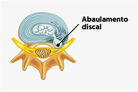 Abaulamento discal o que é sintomas causas e tratamento Tua Saúde