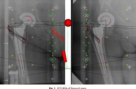 Figure 1 From Identification Of Femoral Head Center Of Bipolar