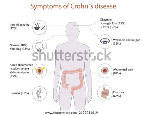 Vector Illustration Crohns Disease Symptoms