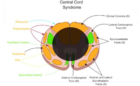 Central Cord Syndrome