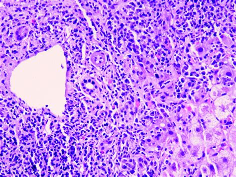 Histological Patterns In Drug Induced Liver Disease Journal Of Clinical Pathology