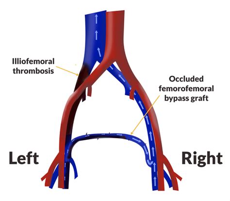 Occluded Femorofemoral Venous Bypass Graft VDM