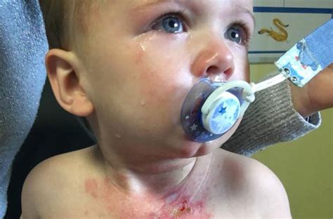 mums warning  son burns   hot drink