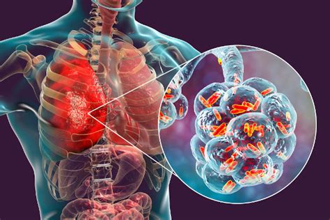 Pneumonia Causas Sintomas Tipos Tratamento Biologia Net