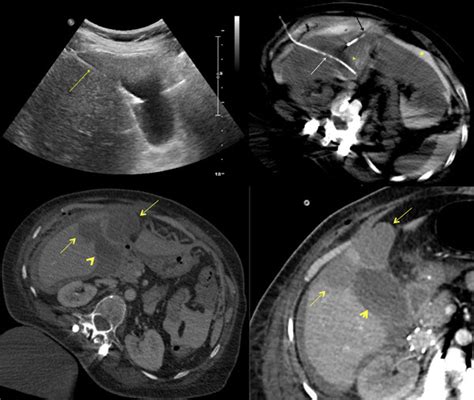 Percutaneous Cholecystostomy And Hydrodissection In Radiofrequency