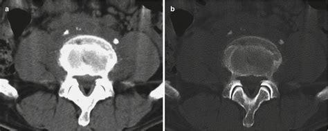 Brucellosis Radiology Key