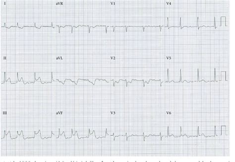 Figure 1 From Double Transseptal Puncture For Catheter Ablation Of