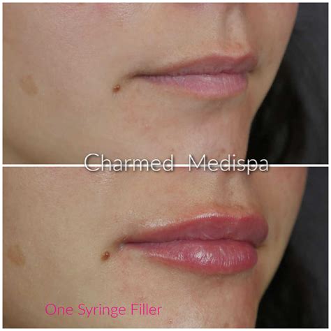 Lip Filler With Less Swelling Charmed Medispa