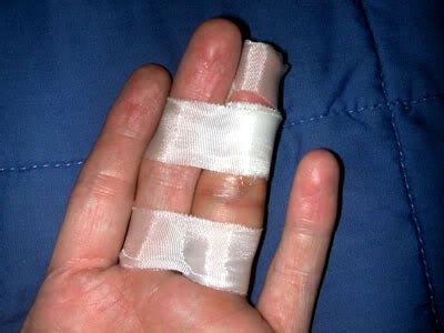 brokenfinger splint - Manchester Hand & Wrist Surgery