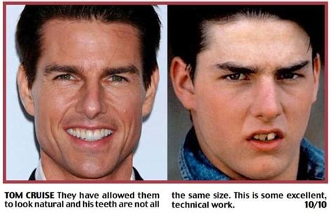 Celebrities with Fake Teeth | List of Famous People with Dentures and Dental Implants