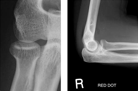 Radial head fracture - filnvoice