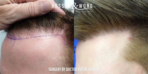 Fue Hair Transplant 2000 Grafts Must See Before And After Photos