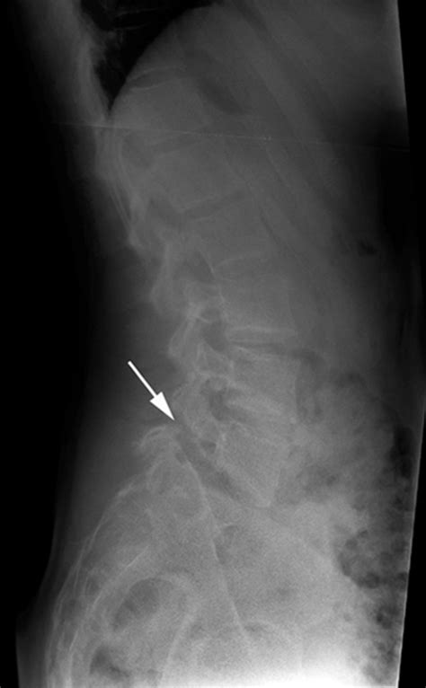 Radiographic And Functional Outcome Of Posterolateral Lumbosacral