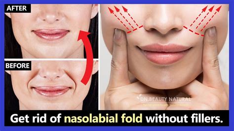 Best Easy Way How To Get Rid Of Nasolabial Folds Laugh Lines