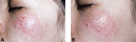 Treatment Of Acquired Bilateral Nevus Of Ota Like Macules Horis Nevus