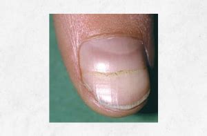 What causes these HORIZONTAL ridges in my fingernails? – Appalachian ...