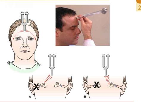 ラブリー Rinne Test Sensorineural Hearing Loss - はがととめ