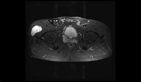 Soft Tissue Sarcoma Mri Radiology Article On Soft Tissue Sarcoma Mri