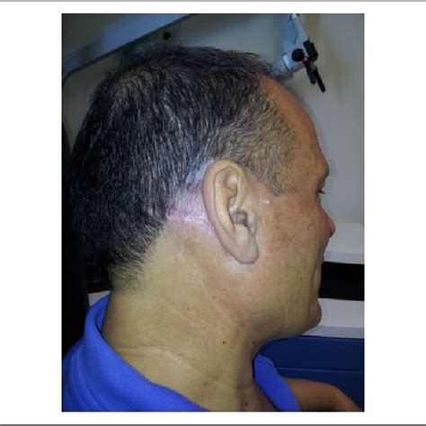 The 1-year postoperative result. The scars are hidden within the scalp ...