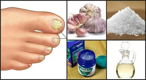 Nasty Nail Fungus What To Do If You Have It Artofit