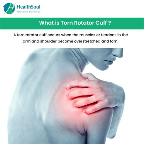 Torn Rotator Cuff Symptoms Diagnosis And Treatment Healthsoul