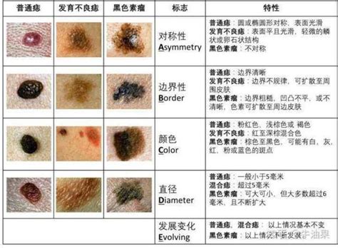 如果你的身體長了一個黑痣突然變化了，小心黑色素瘤 每日頭條