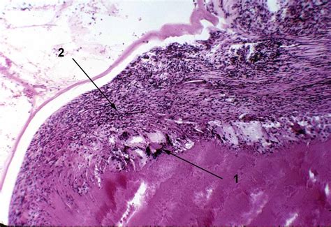 Ocular Pathology: Lens-Induced Granulomatous Endophthalmitis