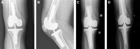 Contemporary Revision Total Knee Arthroplasty In Patients Younger Than