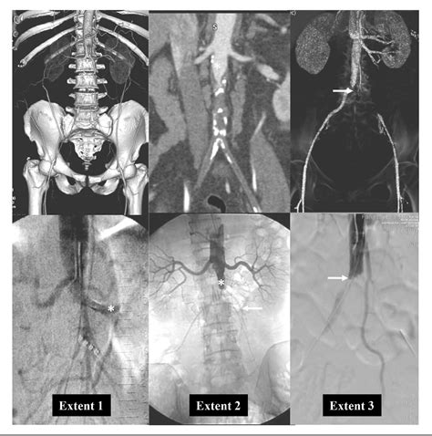 Endovascular Reconstruction For Total AortoIliac Occlusion Semantic