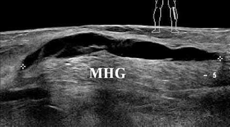 Baker S Cyst With Caudal Extension A Longitudinal Sonogram Shows A