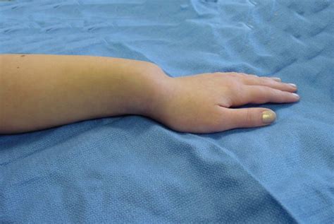 Madelung's Deformity - observation | Hand Surgery Resource