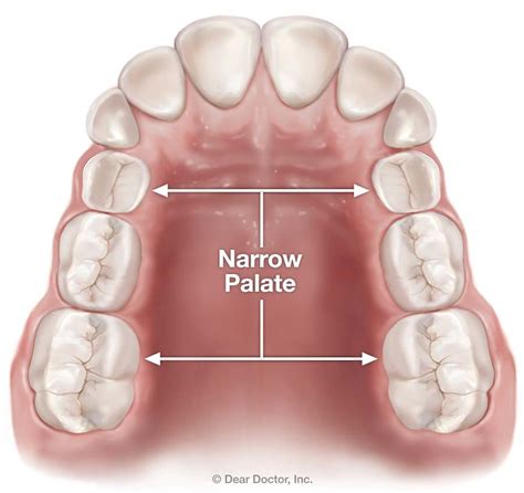 Palatal Expanders Saint Louis South Orthodontics St Louis Missouri