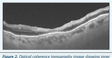 Figure 2 From Postoperative Hemorrhagic Occlusive Retinal Vasculitis