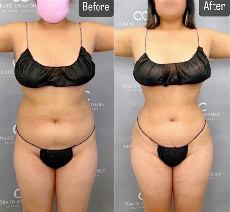 Bbl Smoothsculpt Lipo 360 Be That Beautiful™ Plastic Surgery