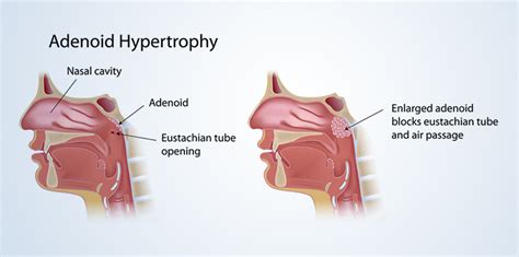 Adenoidectomy Procedure