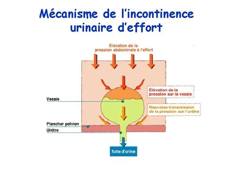 Lincontinence Urinaire De La Personne Ge Une Prise