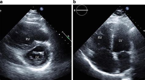 Critical Care Echocardiography: Right Ventricular Dysfunction ...