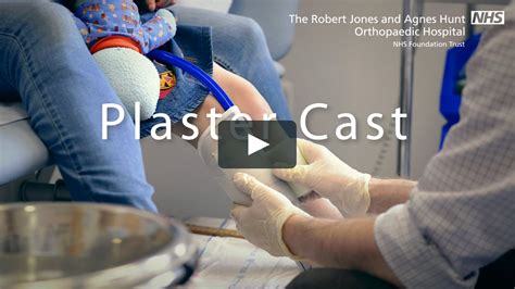 Making A Plaster Cast For An Ankle Foot Orthosis Afo On Vimeo