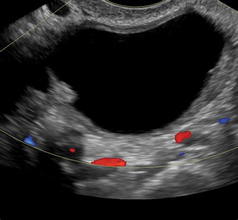 Comparison Of International Ovarian Tumor Analysis Simple Rules To