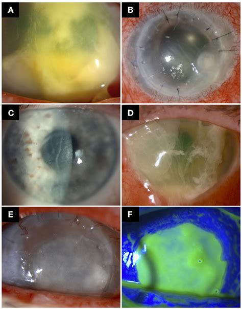 Examples Of Post Keratoplasty Infectious Keratitis Pkik A A Case Download Scientific