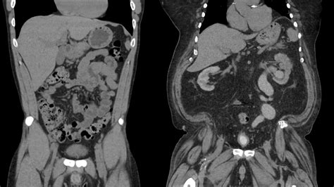 Fat Loss 204 Visualizing Visceral Fat Revitalize Metabolic Health