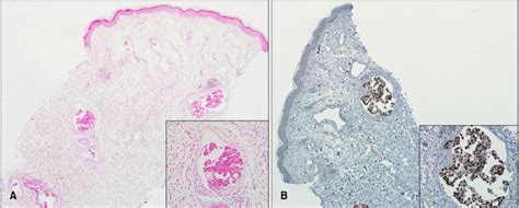 A Well Circumscribed Tumor Nodules In The Lymphatic Vessel Hande