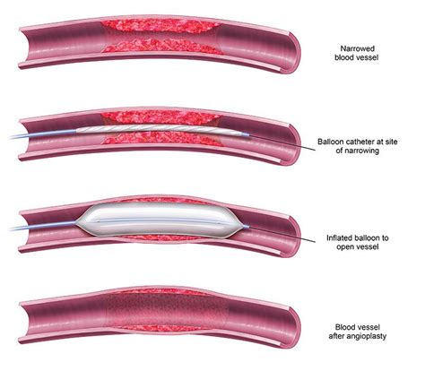 Angioplasty and Stent Placement Procedures | Azura Vascular Care