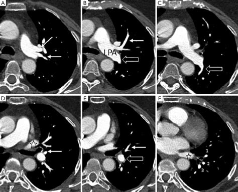 Figure 6 From Pulmonary Vascular Anatomy And Anatomical Variants Semantic Scholar